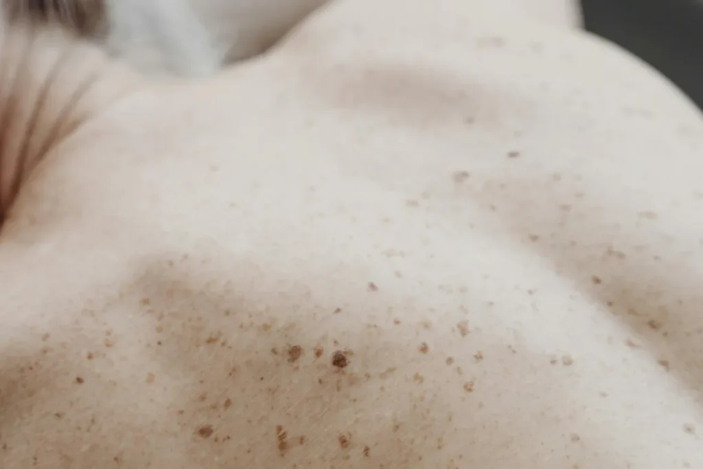 Apaiser les douleurs et favoriser la guérison du zona