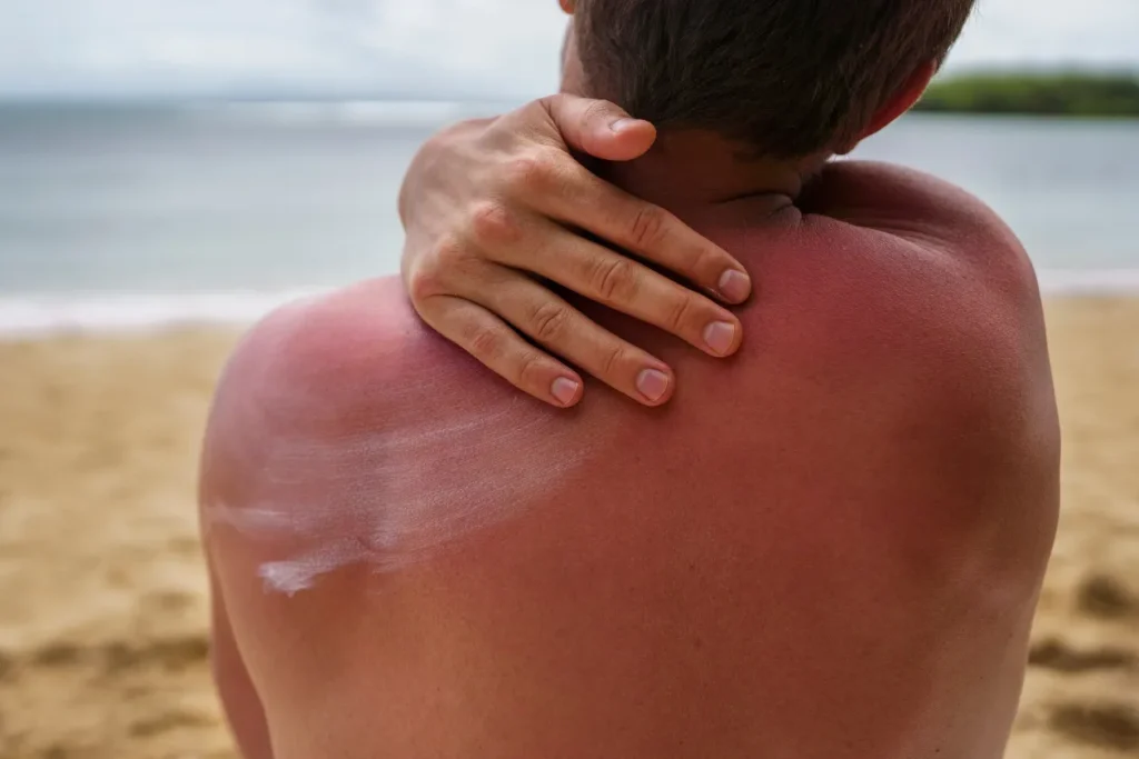 Apaiser un coup de soleil brulure à distance